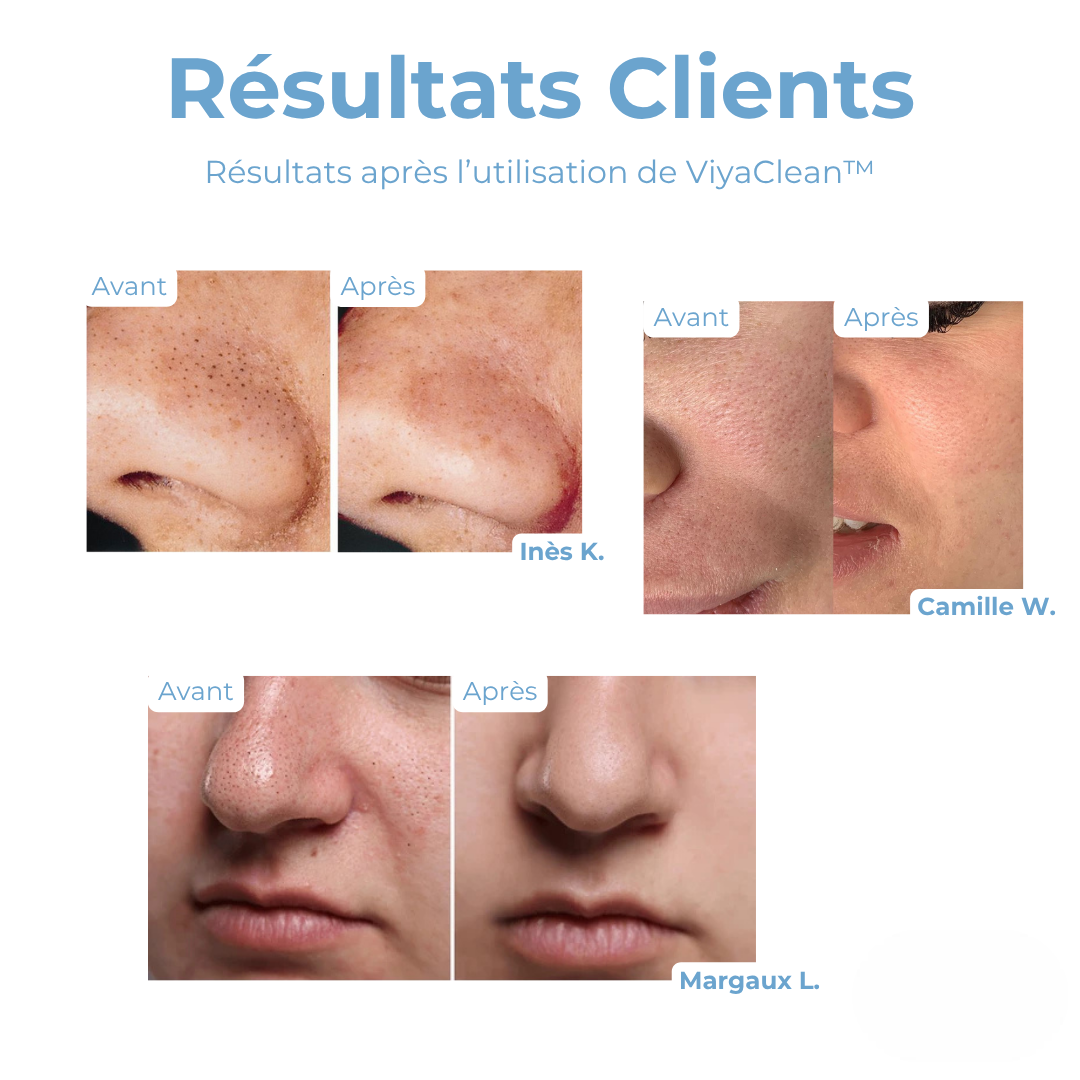 5+5 GRATUIT | ViyaClean™ Sérum Nettoyant pour les Pores