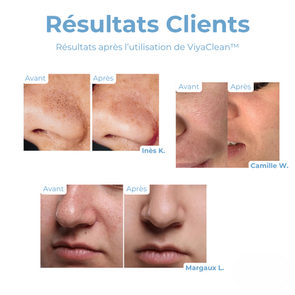 5+5 GRATUIT | ViyaClean™ Sérum Nettoyant pour les Pores